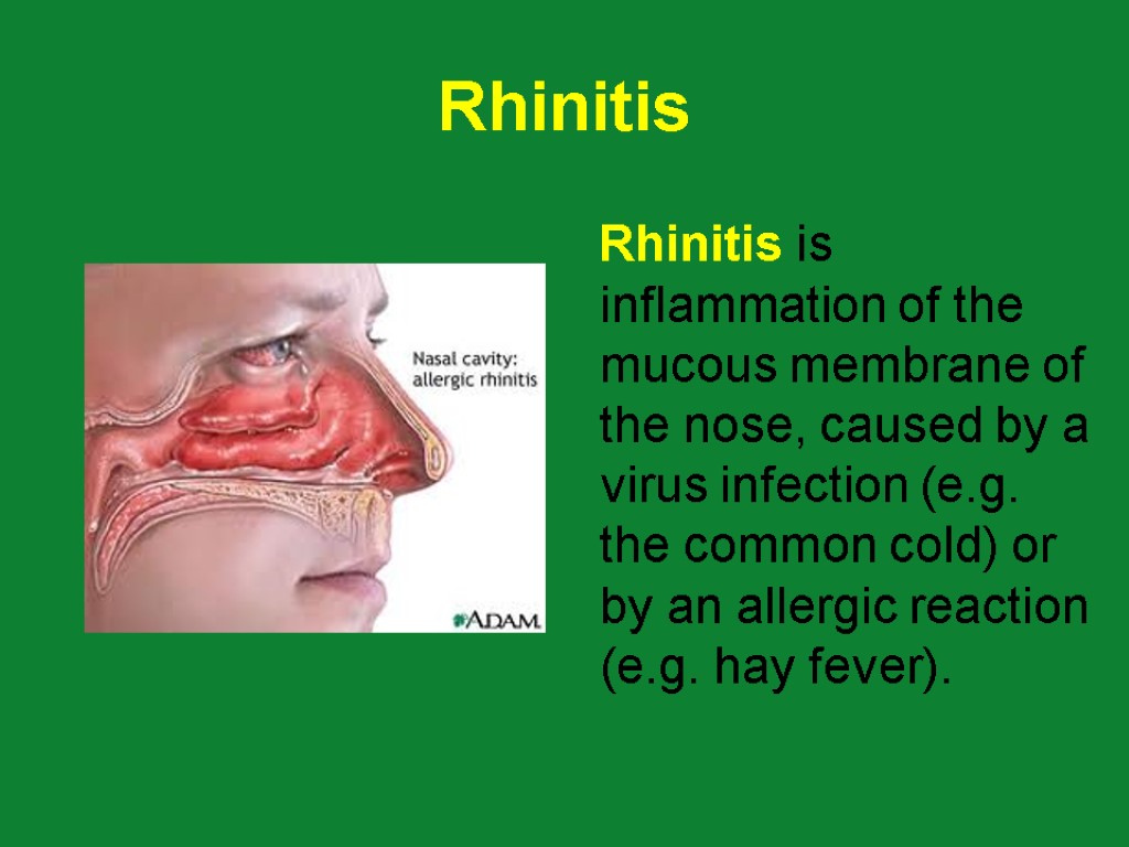 Rhinitis Rhinitis is inflammation of the mucous membrane of the nose, caused by a